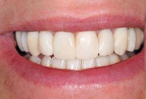 Before and After Dental Fillings in Lady Lake