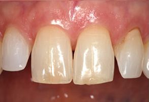 Before and After Amalgam Fillings near The Villages