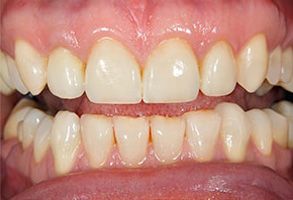 32159 Before and After Amalgam Fillings