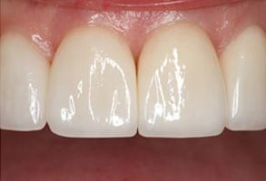 The Villages Before and After Amalgam Fillings