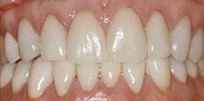 32159 Before and After Invisalign