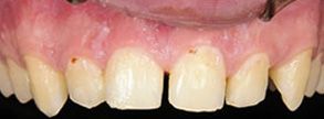 Before and After Dental Fillings near The Villages